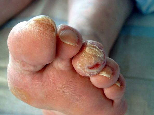Diabetic foot and octastrocytes