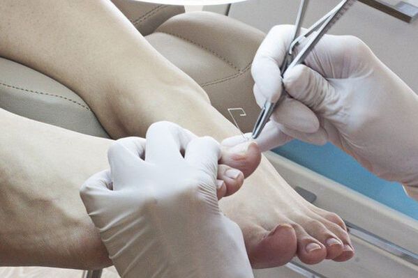 Mechanical removal of fungus-affected nails