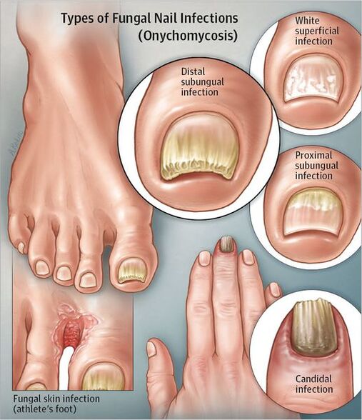 Types of tumor disease