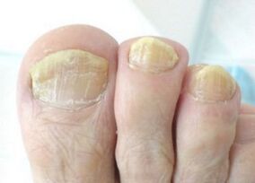 Onychomycosis