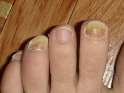Fungus on the feet with nail damage